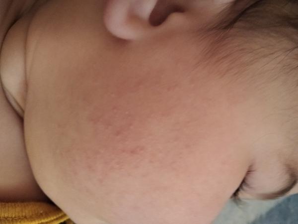 Aké vyrážky to má 8 mesačné bábätko?