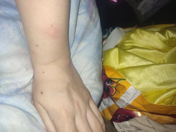 Prečo ma svrbí ruka večer?