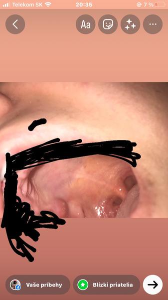 Vytvoril sa mi asi absces