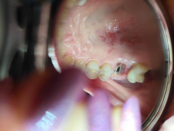 Je veľká diera po extrakcii zuba normálna?