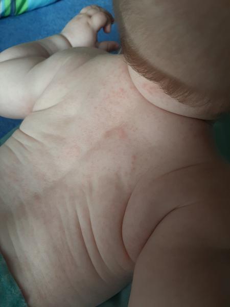 Sú toto potničky alebo alergia?