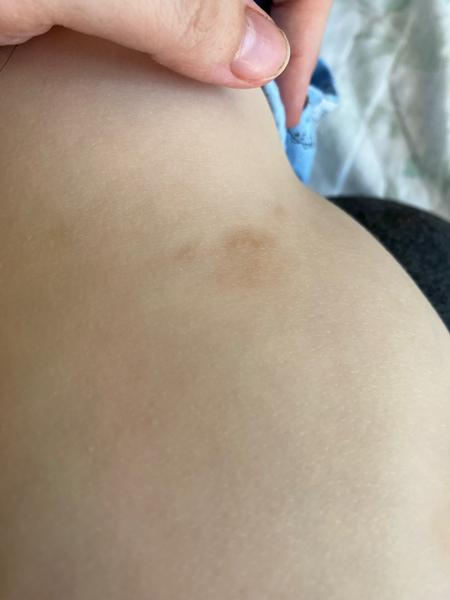 Dvojročnému synovi sa tvoria tmavé fľaky na pokožke. O aký problém môže ísť?