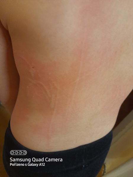 Žihlavka verzus alergia