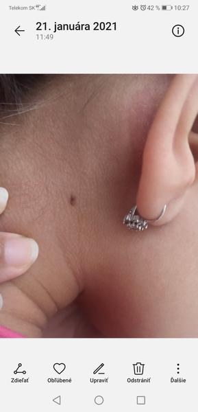 Je znamienko mojej dcérky v poriadku?