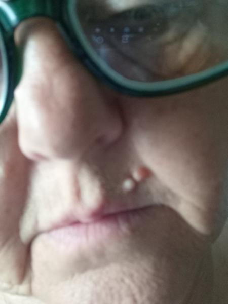 Čo robiť s bledou vyrážkou na tvári?