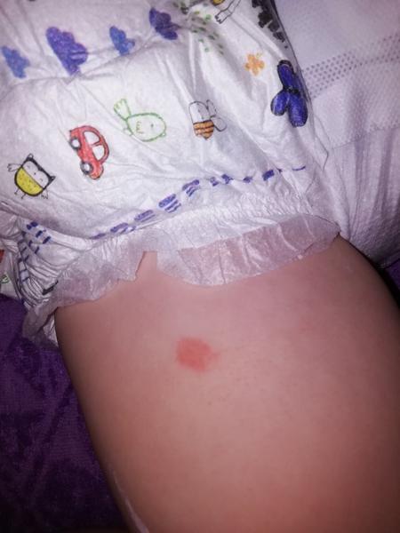 Čo to môže byť za fľak na nôžke 2-ročného syna ? 