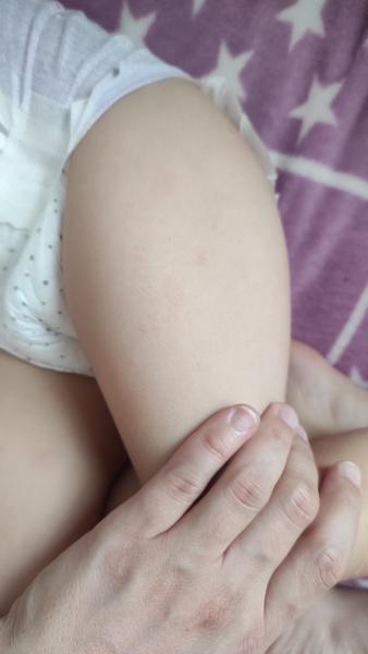 Aké vyrážky má moja dcérka?