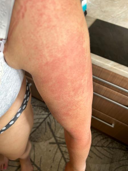 Po pôrode som sa vyhádzala. Môže sa takto prejavovať alergia?