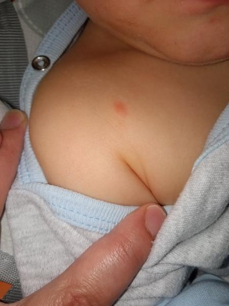 Aká to je vyrážka?