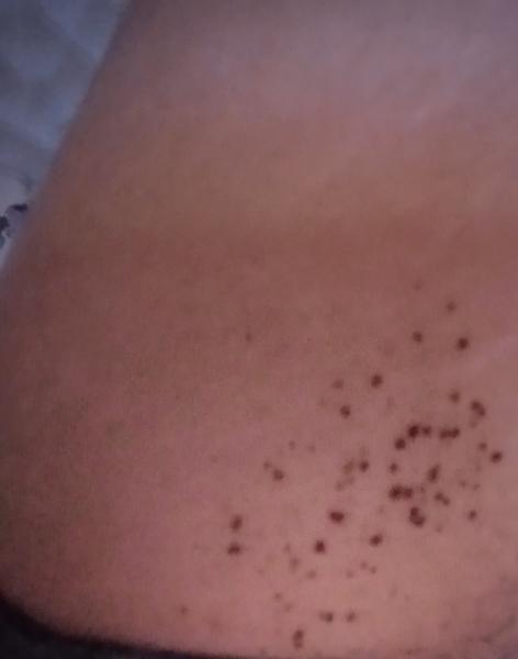 Znamienka pod pazuchou