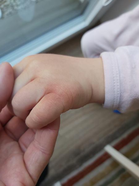 Aký krém odporúčate na kožný ekzém na rukách u 4 ročného dievčatka?