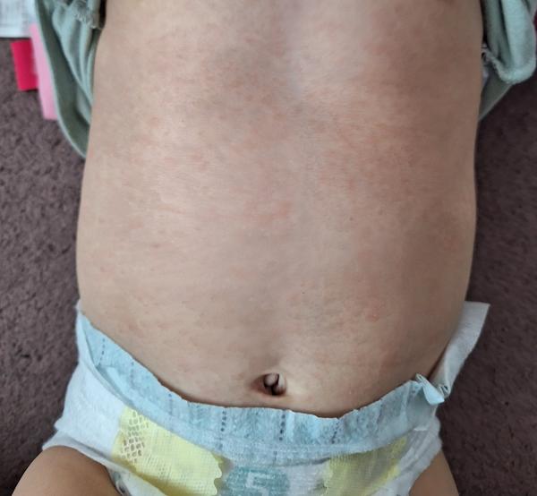 Je toto šarlach alebo šiesta choroba?