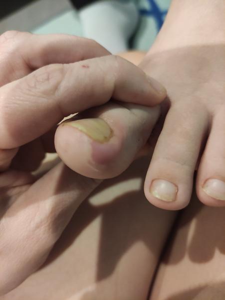 Ako liečiť červené okolo palca po týždni?