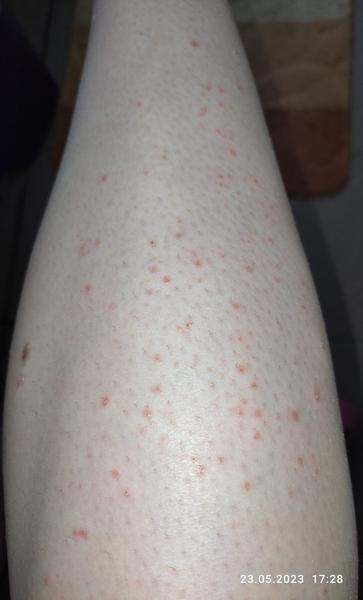 Je to alergia na lieky?