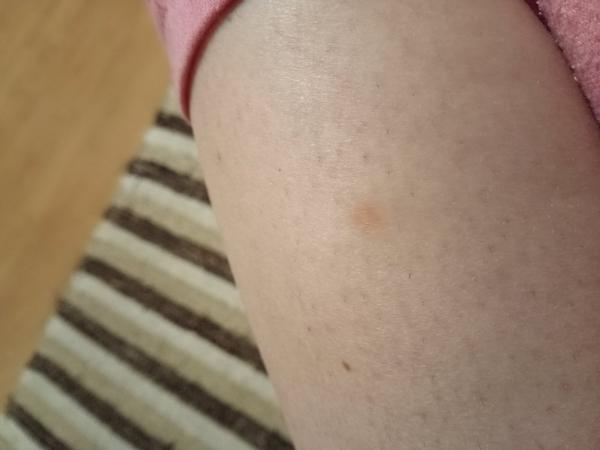 Hnedý fľak na lýtku