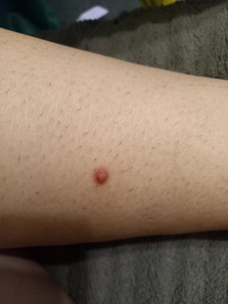 Čo môže byť táto vec na nohe?