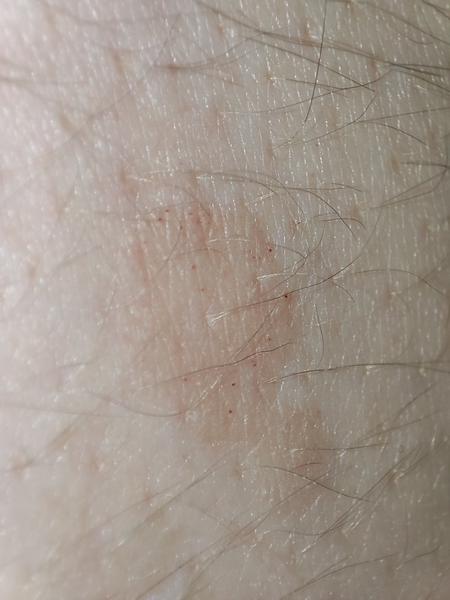 Z čoho sa mi mohli vytvoriť takéto vyrážky?