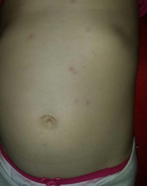 Čo znamenajú tieto vyrážky?