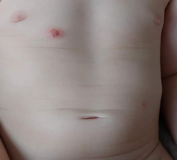 Vyrážky na synovom brušku