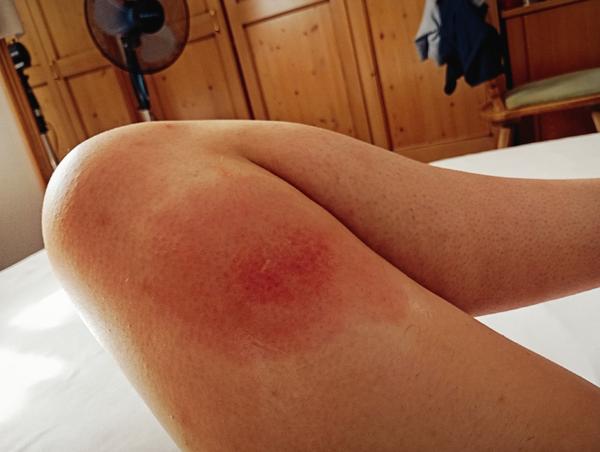 Od čoho môže byť tento štípanec?