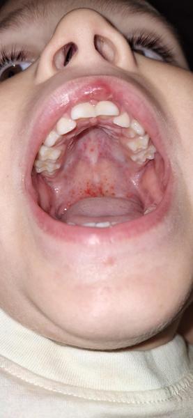 3,5-ročný syn teplotuje, všetko ho bolí