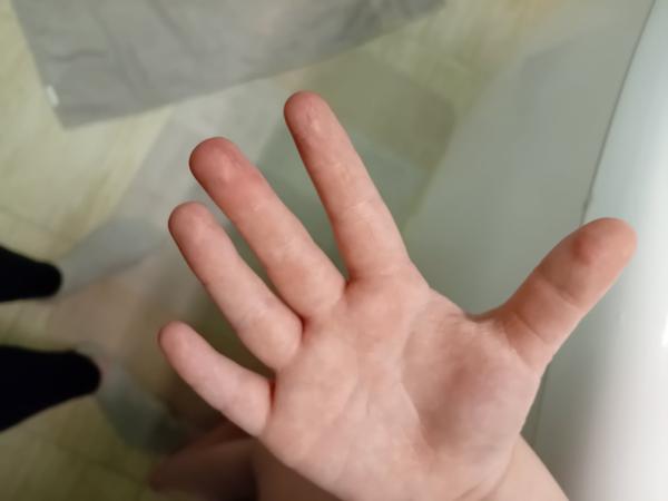 Ekzém na prstoch rúk u 6-ročného dieťaťa: Čo môže byť príčinou?