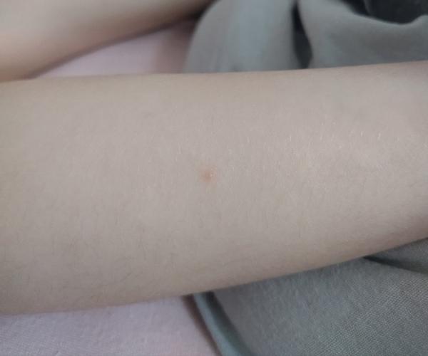 Aká to je vyrážka u 4-ročnej dcérky?