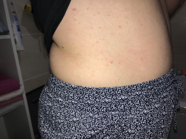 Čo to mám za vyrážky?