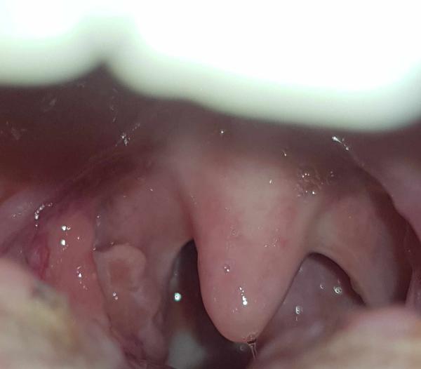 Čo mám v ústach: Je to rakovina?