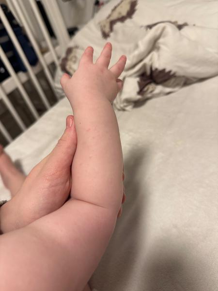 Z čoho môžu byť vyrážky u ročného dieťaťa?