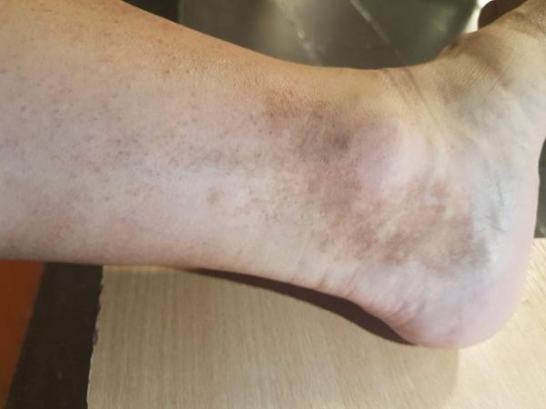 Praskanie drobných ciev - máte s tým skúsenosti?