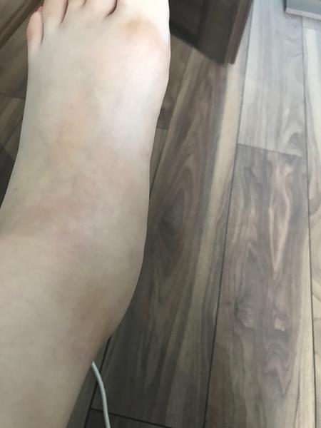 Opuchnuté nohy v 21 týždni