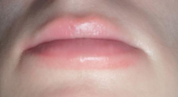 Oliate a opuchnuté pery