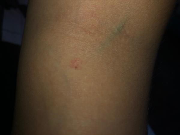 Aké vyrážky sa mi to tvoria na rukách?