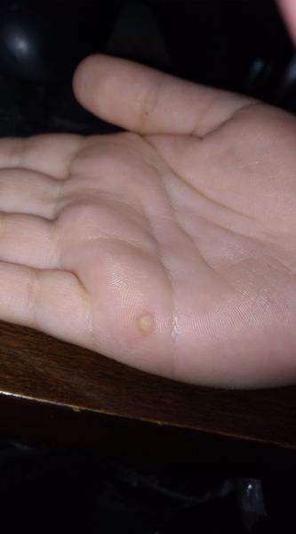 Vyrážka 3 týždne po kiahňach