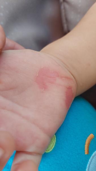 Odreté dlane z lozenia