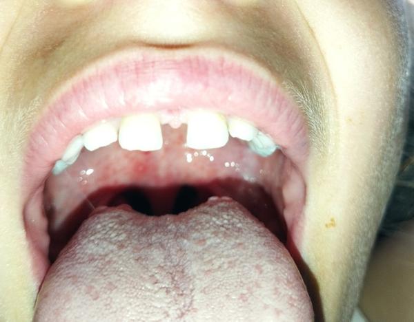 Dcéra má problém s hrdlom