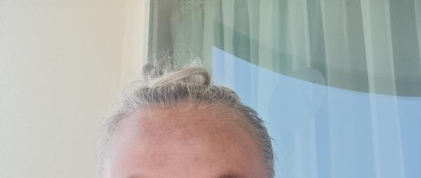 Ako zmierniť pigmentové škvrny na čele?