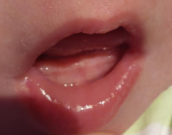 Je možné, aby 5-týždňovému bábätku rástli zuby?