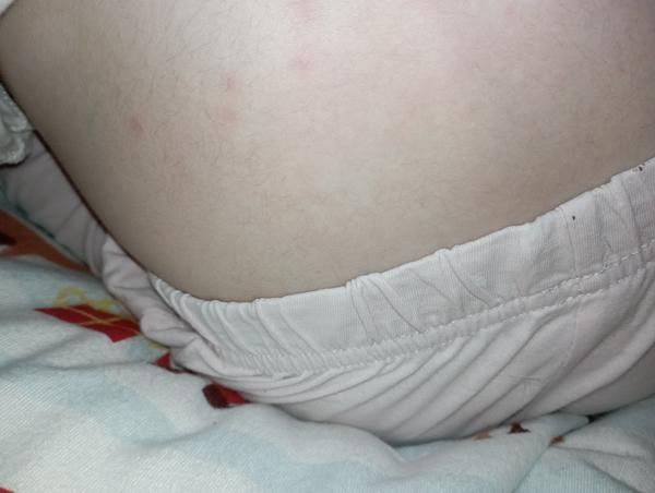 Z čoho sa vytvorili dcérke takéto svrbivé vyrážky?