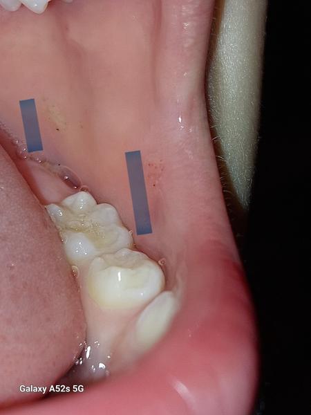 Ako rozpoznať afty v ústach?