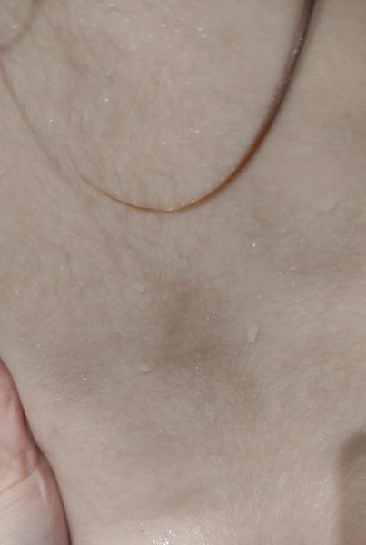 Znamienko - melanóm u 4-ročnej