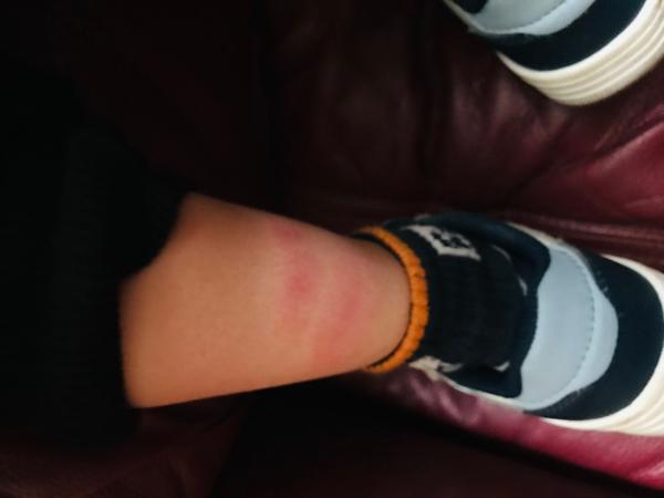 Červené fľaky na nohách u dvojročného dieťaťa