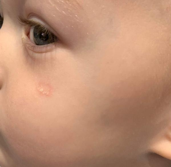 Fľak na líci u synčeka