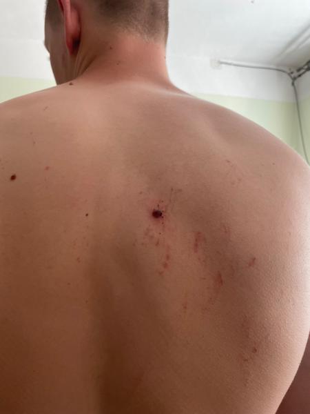 Mám ísť s odtrhnutým znamienkom k lekárovi?