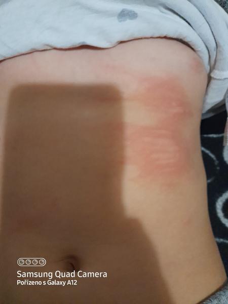 Žihlavka verzus alergia