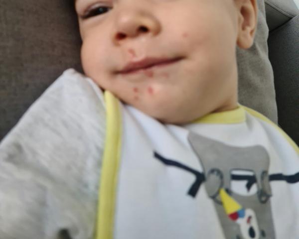 Má moje dieťa kiahne?