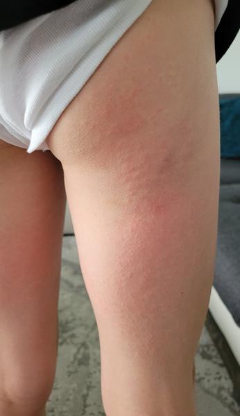 Čo spôsobuje vyrážky u mojho syna?