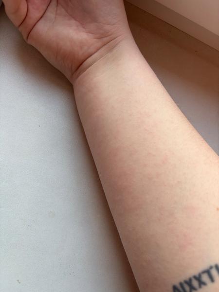 Možné príčiny a liečba vyrážok u dojčiat