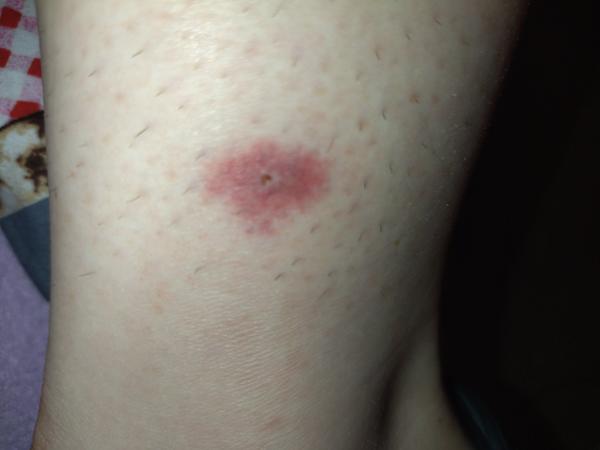 Išli by ste s takýmto štípancom k lekárovi?